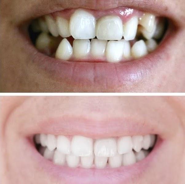 Invisalign® Treatment - Smiles at Summerhill Dental