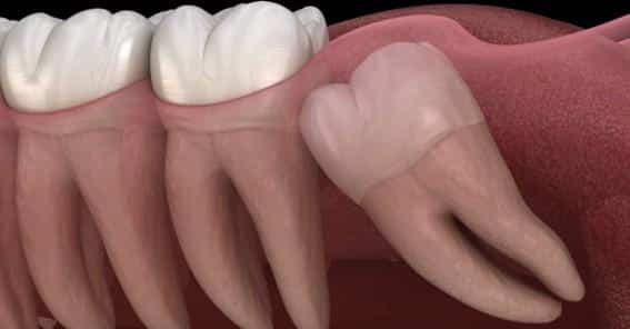 Imagen1 Wisdom Teeth Removal- What You Need To Know