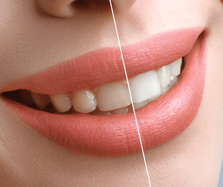 Read More About The Article The Brighter Smile: Unveiling The Magic Of Professional Teeth Whitening