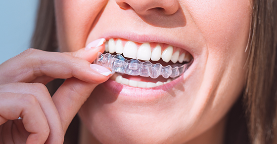 How To Speed Up Your Invisalign Treatment